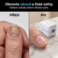 Odstraňte plíseň nehtů bezbolestně modrým světlem – přenosný přístroj na ošetření nehtů. Na dobírku! 💅
